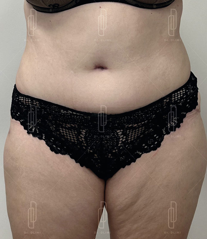 abdominoplastie après intervention